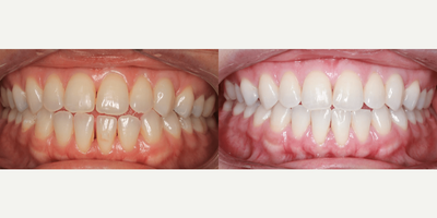 25-34 year old woman treated with Lingual Braces - This adult female patient came to us with mild crowding, a moderate overbite, and moderate overjet. Her lower midline was 2mm to the right of center.