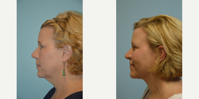 45-54 year old woman treated with ThermiSmooth Face - Patient was treated with Thermi RF and facial liposuction.