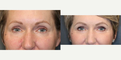 Stem Cell Rich Fat Transfer and Laser - Fat transfer to upper eyelids and face with laser treatment and scar treatment.