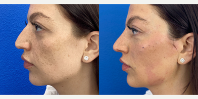 25-34 year old woman treated with Nonsurgical Nose Job - Fillers used to enhance the nose
