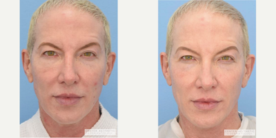 45-54 year old treated with Excel V - ExcelV to Full Face - 1 Session
