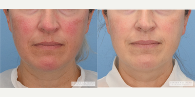 35-44 year old woman treated with Excel V - ExcelV to Full Face - 1 Session