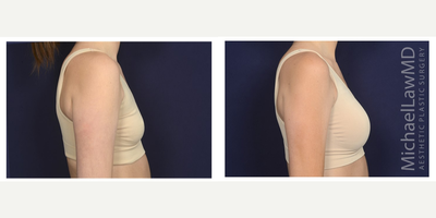 25-34 year old woman treated with Mentor Breast Implants - Breast augmentation. Follow-up photo taken 3 months after the procedure.