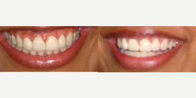 35-44 year old man treated with Lip Lowering - This patient was unhappy with her lip line and gummy smile. Dr. Farnoosh re-positioned her lip and brought it down slightly to show less gum.