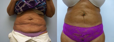 Exilis for skin tightening on post liposuction patient - 
	Patient had 6 Exilis treatments that were spaced 7-10 days apart from eachother. Patient noted that her results continued to get better even months after her final Exilis treatment. These pictures are 6 months after her final Exilis treatment. The patient is extremely happy with her results.
