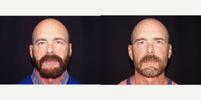55-64 year old man treated with ArteFill - 62 year old male received 4 syringes of Bellafill to the mid-face; photos depict the patient's results 4 months post-treatment.