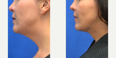 45-54 year old woman treated with Liposuction, MyEllevate - 45-54 year old woman treated with Liposuction, MyEllevate