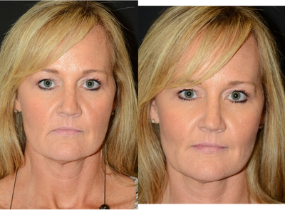 45-54 year old woman treated with Cheek Augmentation - Cheek augmentation with Juvederm Voluma