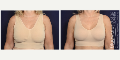 35-44 year old woman treated with Breast Lift with Implants - 42 years - Breast augmentation revision and mastopexy. Follow-up photo taken 3 months after the procedure.