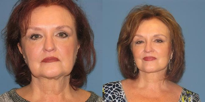 Woman treated with Quick Lift - 3 mo post Quicklift