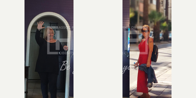 45-54 year old woman treated with Gastric Bypass - Lost 45 kgWe are proud of her.