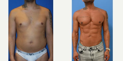 35-44 year old man treated with Pec Implants, Liposuction, Abdominal Etching - 43 year old gentleman now 10 years after pectoral implants and liposuction with abdominal etching performed by Dr Sam Gershenbaum. He had soft solid vertical rectangular pec implants placed under the muscle. He also had liposuction of his waist and abdomen with abdominal etching. With his new body contours and shape, along with disciplined diet and training, he has truly transformed his body and archived his goals in the highest order.