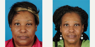 45-54 year old woman treated with Eyelid Surgery, Double Eyelid Surgery, Eyelid Retraction Repair - 49-year-old woman treated with Upper Blepharoplasty, Left Ptosis RepairTime After Surgery: 1 Month