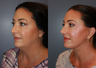 45-54 year old woman treated with Neck Lift - Neck Lift, Upper Eyelid Blepharoplasty