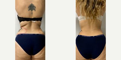 25-34 year old woman treated with CoolSculpting Elite - Patient wanted to diminish excess fat on flanks and create a smooth transition from waist to hips.