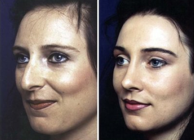 Rhinoplasty - 
	Before and After Rhinoplasty
