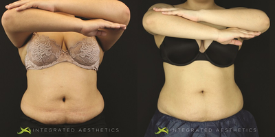 Woman treated with Tummy Tuck - Woman treated with Vanquish