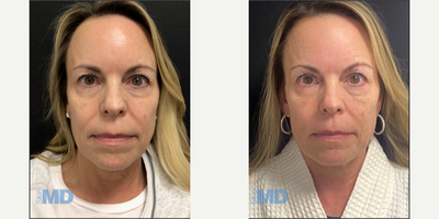 45-54 year old woman treated with Skin Tightening - Morpheus8 Skin Tightening and Remodeling -- Post 2 Treatments