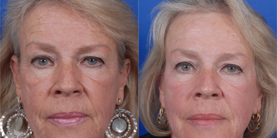 65-74 year old woman treated with Blue Peel - Chemical face peel