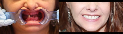 30 year old female treated with All-on-4 Dental Implant Procedure - 30 year old female treated with All-on-4 Dental Implant Procedure