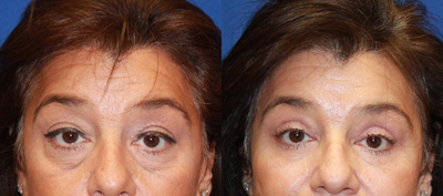 45-54 year old woman treated with Eyelid Surgery - She was not happy with her tired eyes. In addition to her excess lower eyelid fat and excess upper eyelid skin, she also had deep hollows in her cheeks. She underwent an upper eyelid and subciliary lower eyelid blepharoplasty with a fat transfer to her cheeks and tear trough area- all without general anesthesia.