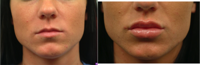 Lip Augmentation - Young outgoing female seeking a more sensual appearance.  I performed a sequential lip augmentation with Juvederm.