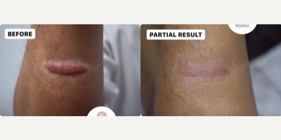 Woman treated with Laser Scar Removal - Woman treated with Laser Scar Removal, Vbeam