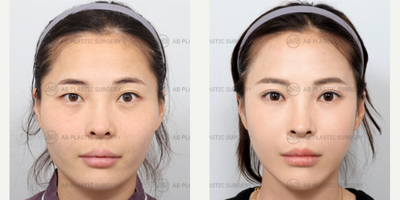 25-34 year old woman treated with Jaw Reduction, Cheekbone Reduction, Double Eyelid Surgery - Mandible Jaw Reduction, Cheekbone ReductionIncisional Double Eyelid Revision