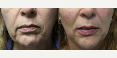 Woman treated with Dermal Fillers - Woman treated with Dermal Fillers