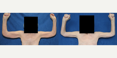 75 and up year old woman treated with Arm Lift - This is a 79-year-old white female patient who underwent a brachioplasty and forearm reduction surgery with Dr. J. Timothy Katzen in Beverly Hills, CA. Standing at 5'6 and weighing 169 pounds, the patient had experienced a weight loss of 34 pounds. However, she was unhappy with the excess skin and fat in her arms.The surgery, which lasted for approximately 4 hours, aimed to address the patient's concerns. Dr. Katzen skillfully removed 1 pound of excess skin and fat from the patient's arms, resulting in a more toned and contoured appearance. The combination of brachioplasty and forearm reduction allowed for a comprehensive improvement in the patient's arm aesthetics.Following the procedure, the patient expressed her satisfaction with the results. The removal of the excess skin and fat has greatly enhanced her self-confidence and overall well-being. Dr. J. Timothy Katzen's expertise and the advanced techniques utilized during the surgery played a significant role in achieving the desired outcome.It is important to note that cosmetic procedures like brachioplasty can have a transformative impact on individuals, helping them regain their confidence and improve their quality of life. If you have any further questions or would like more information, feel free to ask.