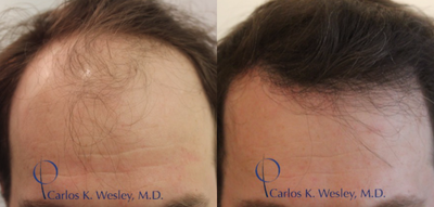 35-44 year old man treated with Hair Transplant - Patient treated with Follicular Unit Transplant (FUT)12 months post op. The hair follicles were incubated in autologous (his own) platelet rich plasma (PRP) throughout the duration of the procedure. This, combined with an ATP-containing storage solution has been shown to enhance survival of transplanted hairs.