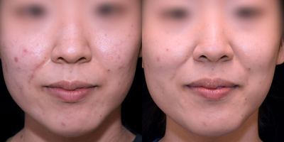 25-34 year old woman treated with Clear and Brilliant - This patient underwent multiple clear and brilliant laser treatments. Each treatment was spaced 6-8 weeks apart.