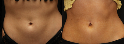 18-24 year old woman treated with Belly Button Surgery - Belly button ring scar revision