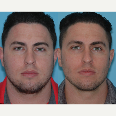 25-34 year old man treated with Buccal Fat Removal - 3 months after buccal fat reduction and kybella for the submentum to improve jawline definition
