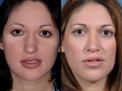 Rhinoplasty - 
	This primary rhinoplasty patient underwent correction of her over-projecting, droopy tip.
