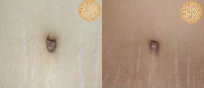 35-44 year old woman treated with Belly Button Surgery - Belly button revision after someone else's tummy tuck