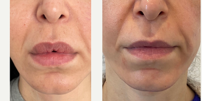 25-34 year old woman treated with Silicone Injection Removal - Removal of silicone biopolymers and lip lift performed at the same time by Dr. Raffy Karamanoukian in Los Angeles.
