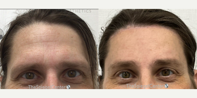 Man treated with Forehead Reduction - Man treated with Forehead Reduction