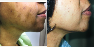 55-64 year old woman treated with Pico Genesis - After 2 treatments.