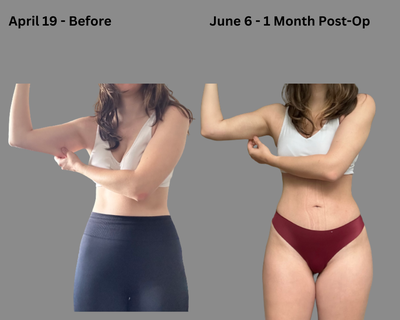 AirSculpt - Arms & Full Abdomen + BBL Fat Transfer to Butt 