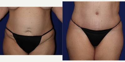 45-54 year old woman treated with Mommy Makeover - Abdominal with 360* circumferential poer lipsuction with Vaser