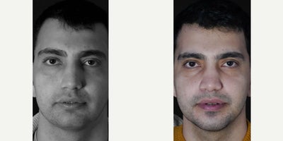 Man treated with Jaw Surgery - The duration of orthognathic surgery and subsequent treatment, especially when following the Surgery First method, varies depending on the complexity of the case but is generally faster than traditional methods. The actual surgery, which corrects the jaw position, typically takes about 34 hours under general anesthesia. We reduce surgery time by using AI image technology and other surgical planning devices.