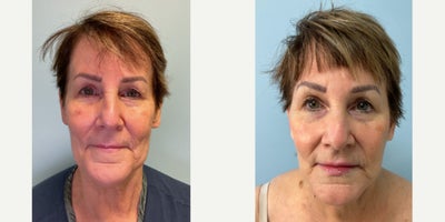 65-74 year old woman treated with Neck Lift, Facelift, Renuvion, MyEllevate - This case involves a 69-year-old female patient who underwent a MyEllevate, Renuvion, facelift, and neck lift procedure. The post-operative results were documented two months following the surgery. Tumescent fluid was then infiltrated into the subcutaneous space of the face and neck; 500 ccs per side. The before-and-after images display observable changes in the jawline and neck area. In the after photo, there is a notable reduction in skin laxity around the neck and a more defined jawline contour compared to the pre-operative image. The skin texture appears smoother and more uniform. These outcomes reflect typical physical adjustments associated with these procedures within the given timeframe. This description is based solely on visible changes noted in the photographs provided without implying future results or patient satisfaction.