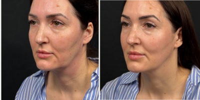35-44 year old woman treated with Endolift - Jowling and loss of jawline definii