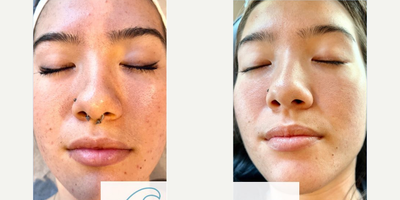 Woman treated with AviClear - Woman treated with AviClear