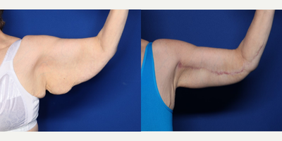 55-64 year old woman treated with Arm Lift - 61 year old female shown 7 months after an extended bilateral brachioplasty. She had a 120 pound weight loss prior to surgery.