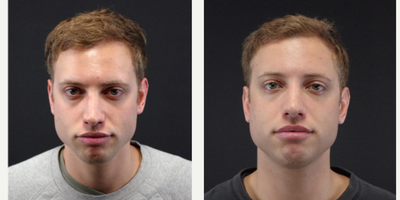 25-34 year old man treated with Bellafill for a Liquid Rhinoplasty - 29 year old male received 2 syringes of Bellafill to the nose for a Liquid Rhinoplasty; photos depict the patient's results 2 months post-treatment.