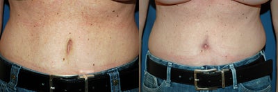 tummy tuck revision - 
	belly button revision in a tummy tuck
