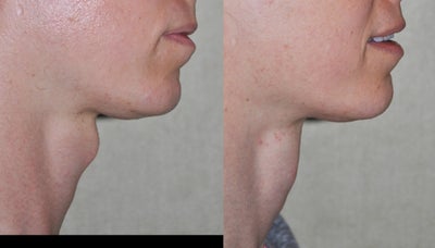 35 Year Old Female Treated For Prominent Adam's Apple - Young female treated for neck feminization by adam's apple reduction. (tracheal shave)