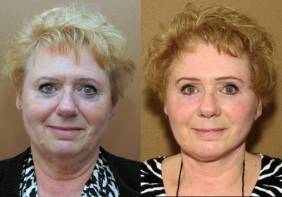Modern facial rejuvenation - 
	Complex but natural facial rejuvenation -a combination of a brow lift (endoscopic) blepharoplasty, midface lift and neck lift will look most natural
